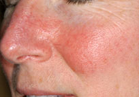 VBeam for Rosacea-Before